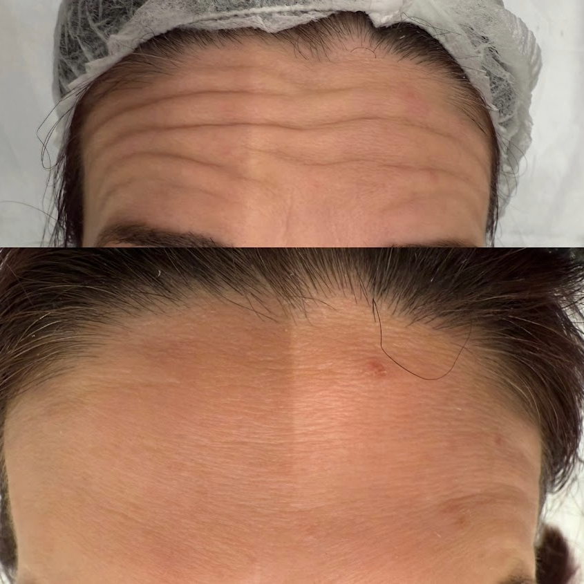 Toxina Botulínica - Antes e depois caso 1