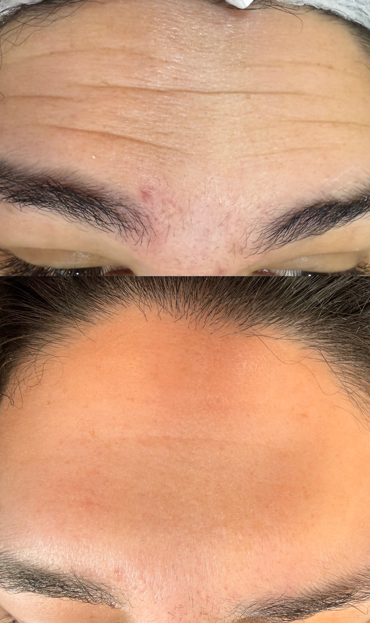 Toxina Botulínica - Antes e depois caso 2