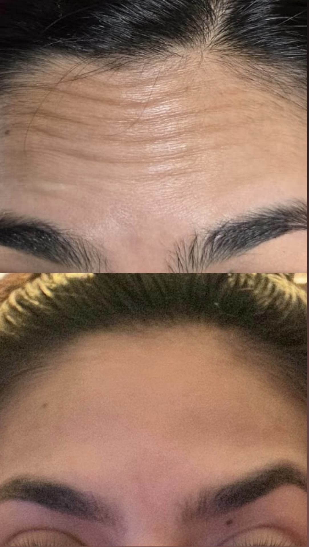 Toxina Botulínica - Antes e depois caso 3