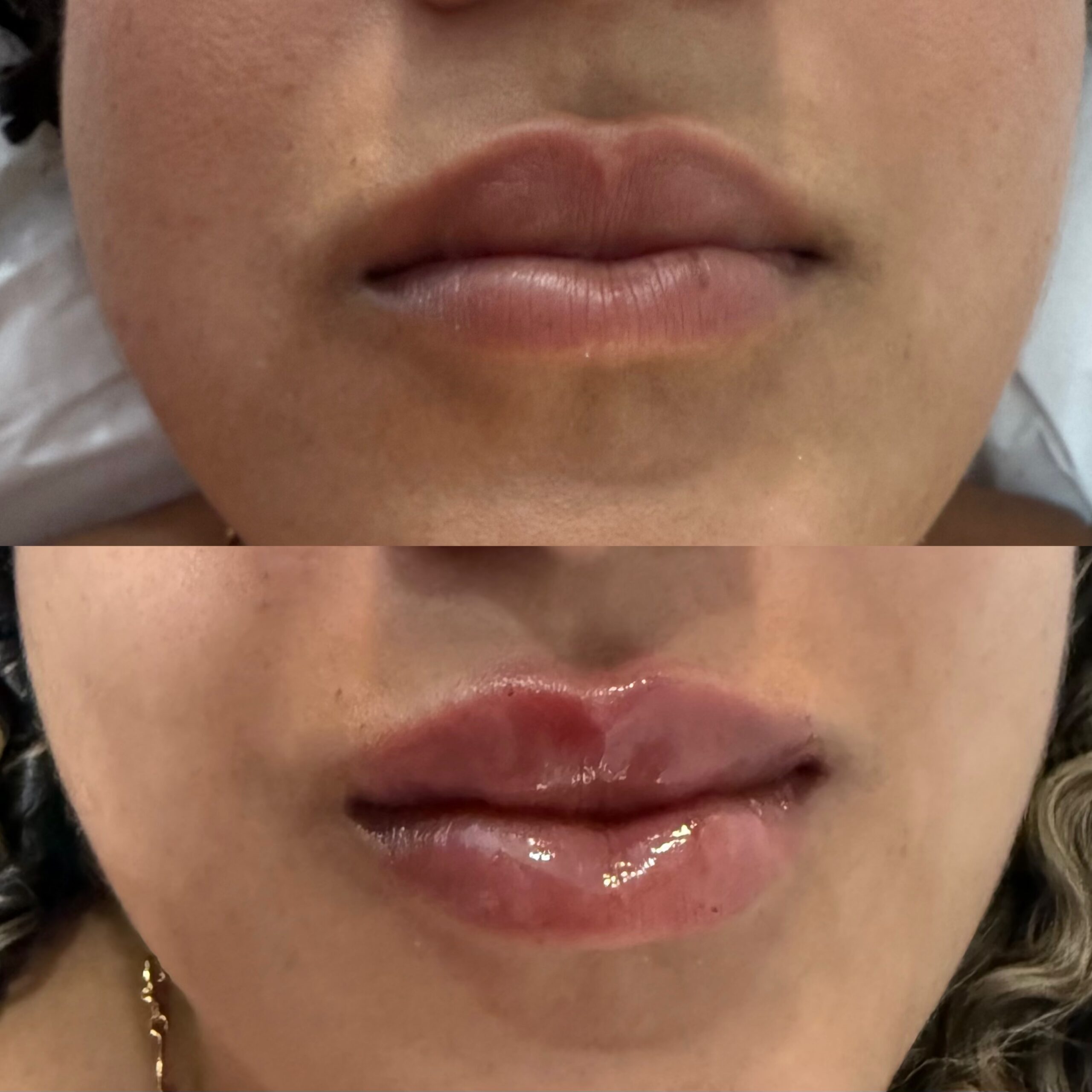 Preenchimento labial - Antes e depois caso 1