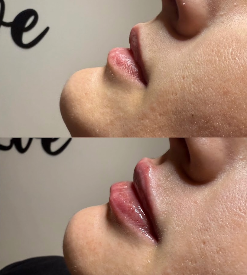 Preenchimento labial - Antes e depois caso 2
