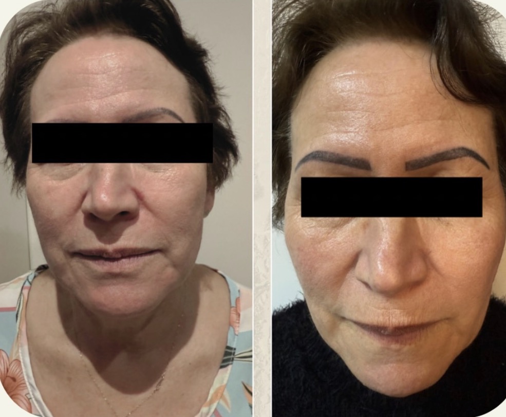 Bioestimulador de colágeno - Antes e depois