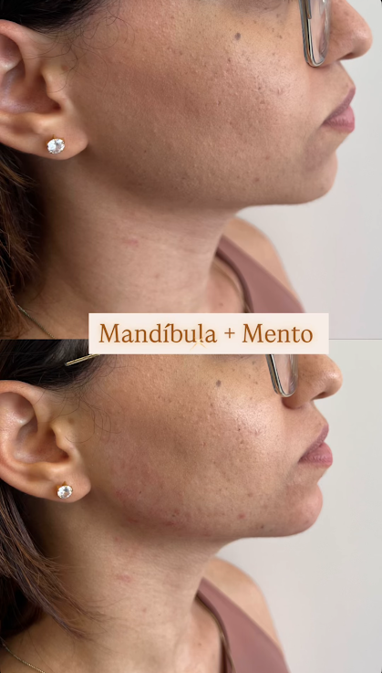 Harmonização de mandíbula e mento - Antes e depois
